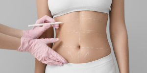 Free Liposuction Consultation in Alexandria Virginia